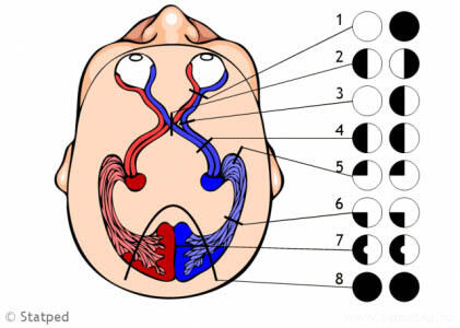 Illustrasjon av synsutfall i et menneskehode.