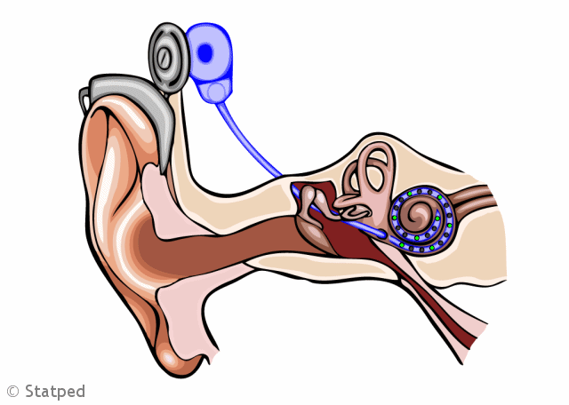 Illustrasjon av CI, der elektrodene i sneglehuset beveger seg. 