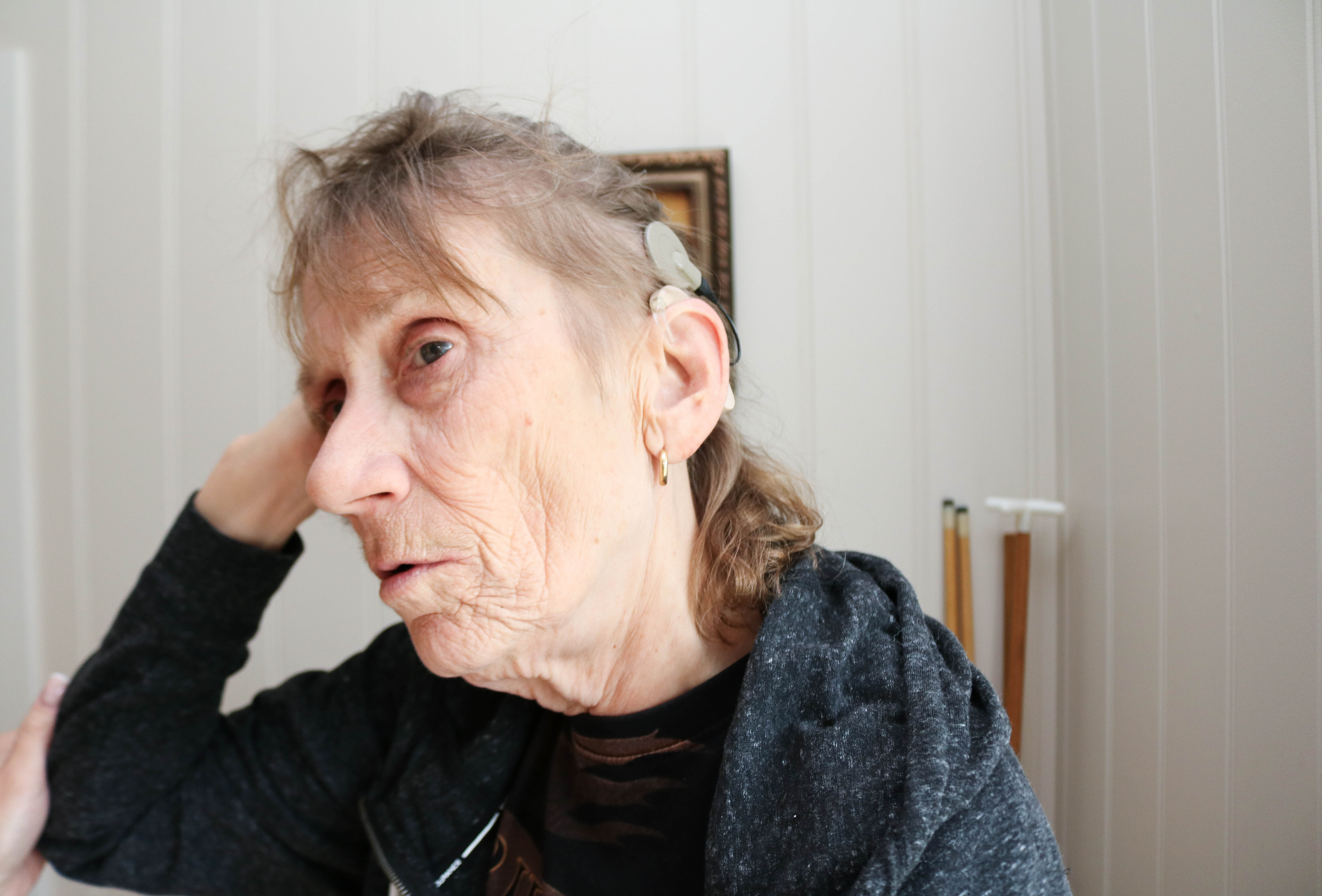 Døvblind dame viser fram sitt cochleaimplantat (CI) på venstre øre. 